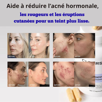 Complément hormonal contre l'acné